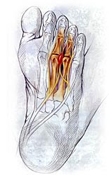 neuroma